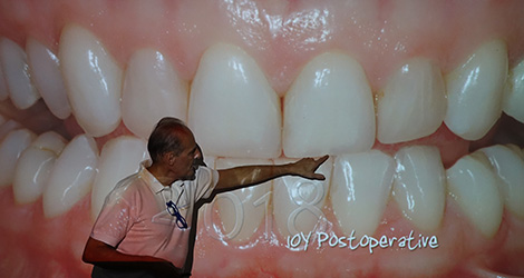 conservative rehabilitation of tooth