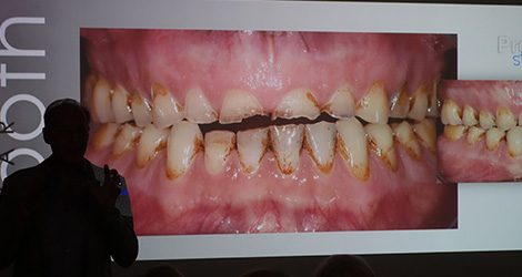 conservative rehabilitation of tooth