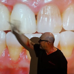 conservative-rehabilitation-of-tooth